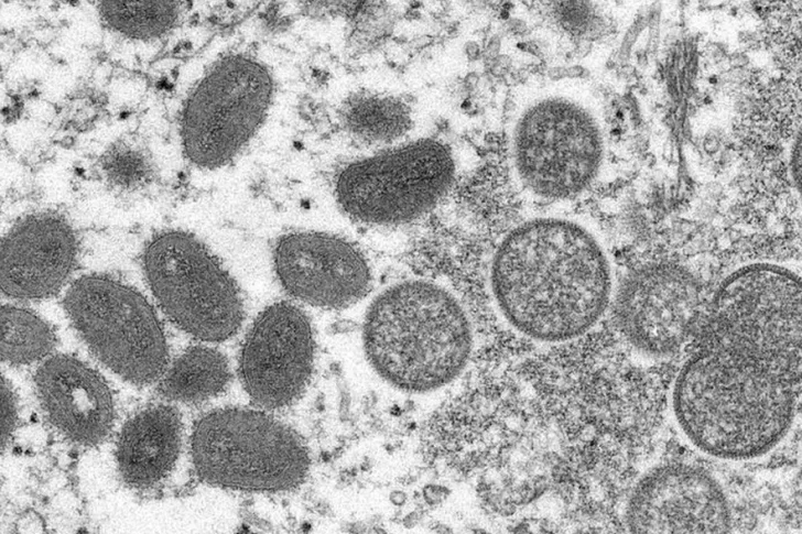 Confirmaron el quinto caso de viruela del mono en el país