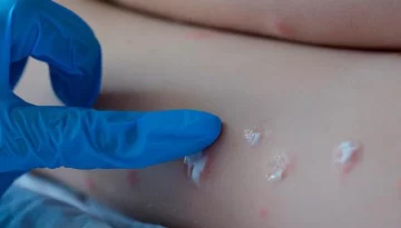 La OMS deja de distinguir países endémicos y no endémicos en datos sobre viruela del mono