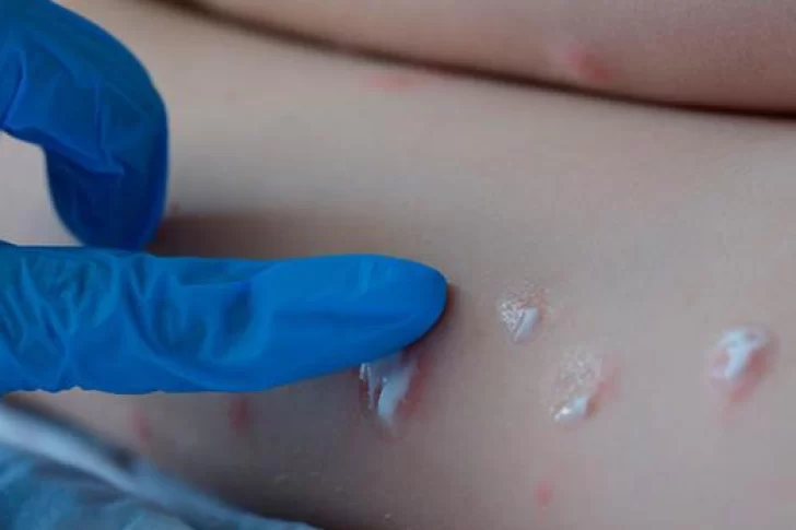 La OMS deja de distinguir países endémicos y no endémicos en datos sobre viruela del mono