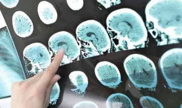 Destacan los resultados de un fármaco contra el Alzheimer, pero advierten sobre efectos secundarios Destacan los resultados de un fármaco contra el Alzheimer, pero advierten sobre efectos secundarios