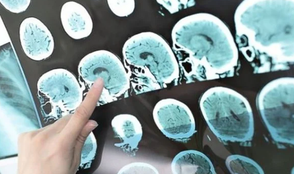 Destacan los resultados de un fármaco contra el Alzheimer, pero advierten sobre efectos secundarios Destacan los resultados de un fármaco contra el Alzheimer, pero advierten sobre efectos secundarios