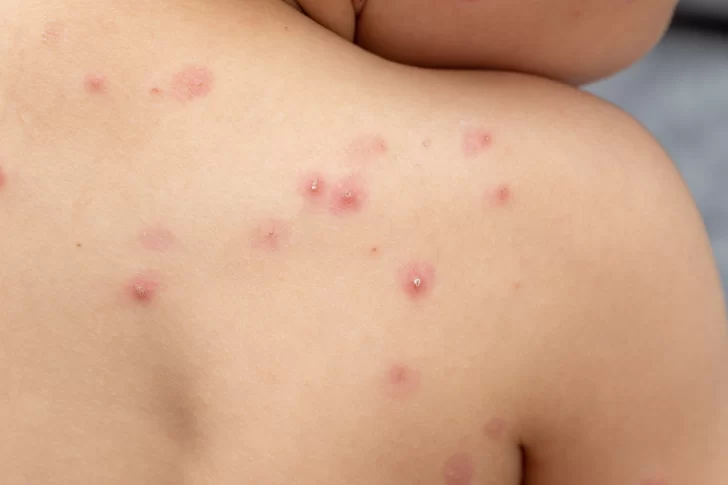 Confirmaron un 80% más de casos de viruela del mono que la semana pasada en Argentina