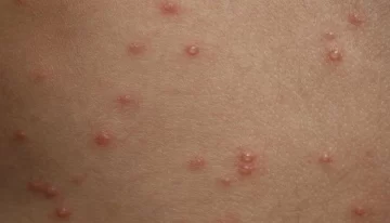 Detectan un posible caso de sarampión en CABA: lo habría contraído en Maldivas Detectan un posible caso de sarampión en CABA: lo habría contraído en Maldivas