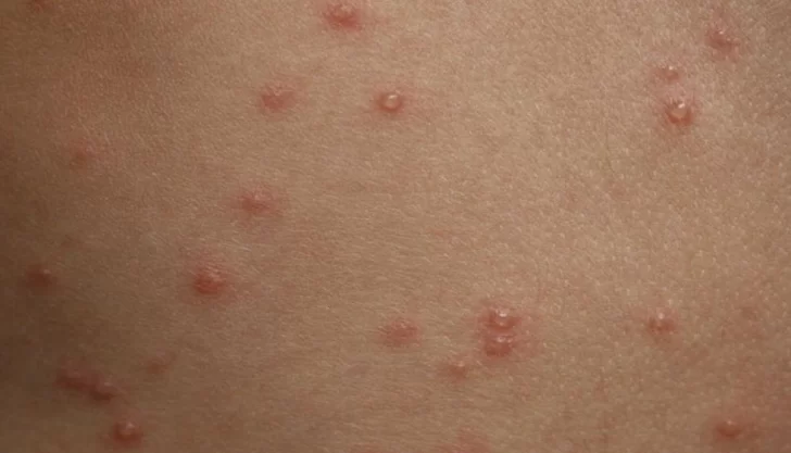 Detectan un posible caso de sarampión en CABA: lo habría contraído en Maldivas Detectan un posible caso de sarampión en CABA: lo habría contraído en Maldivas