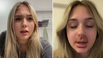 Gastó casi 800 dólares en un tratamiento de labios y le quedaron “como Homero Simpson” Gastó casi 800 dólares en un tratamiento de labios y le quedaron “como Homero Simpson”