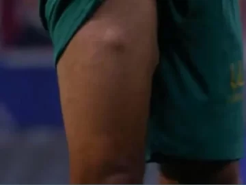 Video: la extraña lesión que sufrió un jugador del Cádiz Video: la extraña lesión que sufrió un jugador del Cádiz