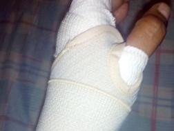 Llegó al hospital con la muñeca fracturada y contó que lo atacaron en un intento de robo