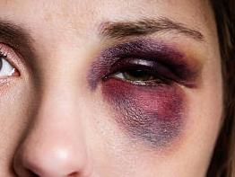 Su novio le dio una trompada y no quiso denunciarlo: sus padres sí lo hicieron Su novio le dio una trompada y no quiso denunciarlo: sus padres sí lo hicieron