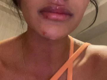 Denunció a su pareja porque la había agredido y el hombre se desquitó reventándole el labio Denunció a su pareja porque la había agredido y el hombre se desquitó reventándole el labio