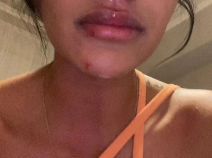 Denunció a su pareja porque la había agredido y el hombre se desquitó reventándole el labio Denunció a su pareja porque la había agredido y el hombre se desquitó reventándole el labio