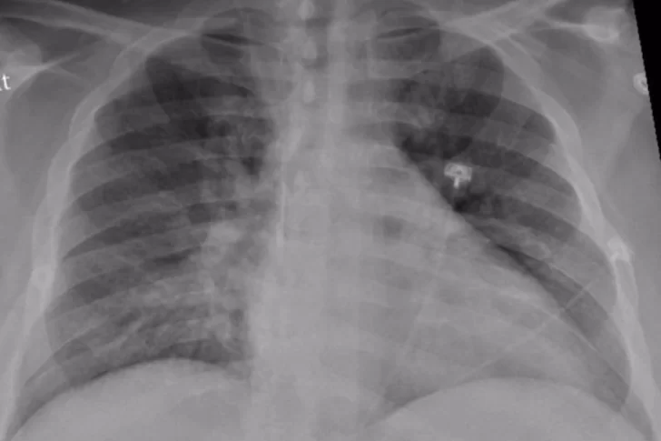 Tercera muerte por neumonía bilateral de origen desconocido