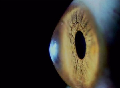 Revelan una nueva secuela del Covid-19 que afecta los ojos Revelan una nueva secuela del Covid-19 que afecta los ojos