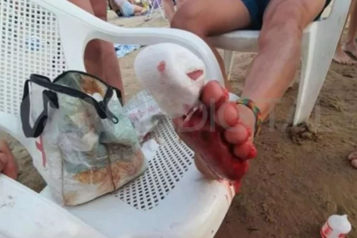 Impresionante ataque de palometas: hubo 30 heridos y una adolescente perdió un dedo