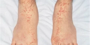 Cómo son las manchas en la piel que pueden indicar que una persona tuvo Covid Cómo son las manchas en la piel que pueden indicar que una persona tuvo Covid