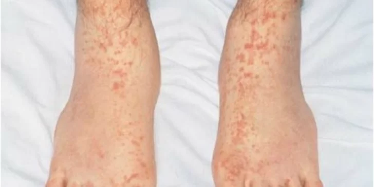 Cómo son las manchas en la piel que pueden indicar que una persona tuvo Covid Cómo son las manchas en la piel que pueden indicar que una persona tuvo Covid