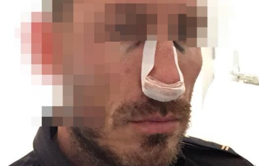 Le rompieron el tabique de una trompada en un intento de robo Le rompieron el tabique de una trompada en un intento de robo