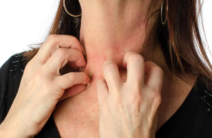 Cuáles son las cinco enfermedades más comunes del verano y cómo cuidarse Cuáles son las cinco enfermedades más comunes del verano y cómo cuidarse