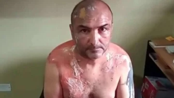 Denunció que su exesposa le tiró agua hirviendo cuando se estaban separando Denunció que su exesposa le tiró agua hirviendo cuando se estaban separando