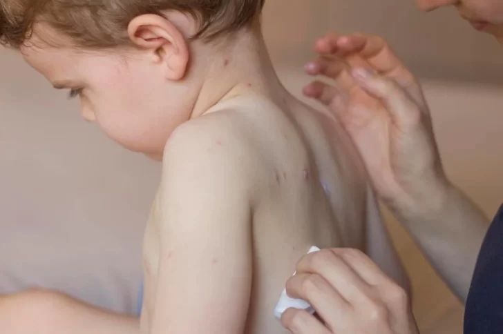 Una nena de 2 años, el primer caso de sarampión en el país después de 6 años Una nena de 2 años, el primer caso de sarampión en el país después de 6 años