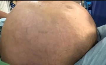 Impactante: extirparon el tumor más grande del mundo