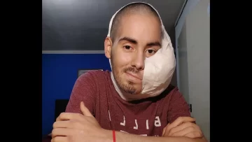 Murió Sebastián Amurín, el joven de 25 años que tenía un tumor en el rostro Murió Sebastián Amurín, el joven de 25 años que tenía un tumor en el rostro