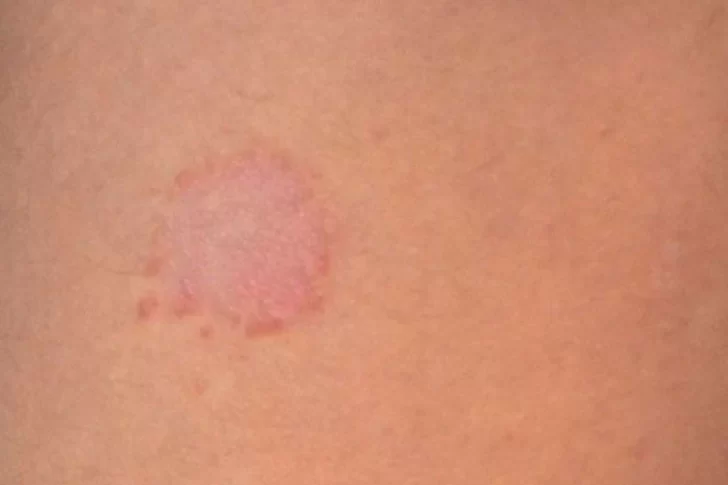 Científicos desarrollaron un test cutáneo para saber si se necesita una dosis de refuerzo