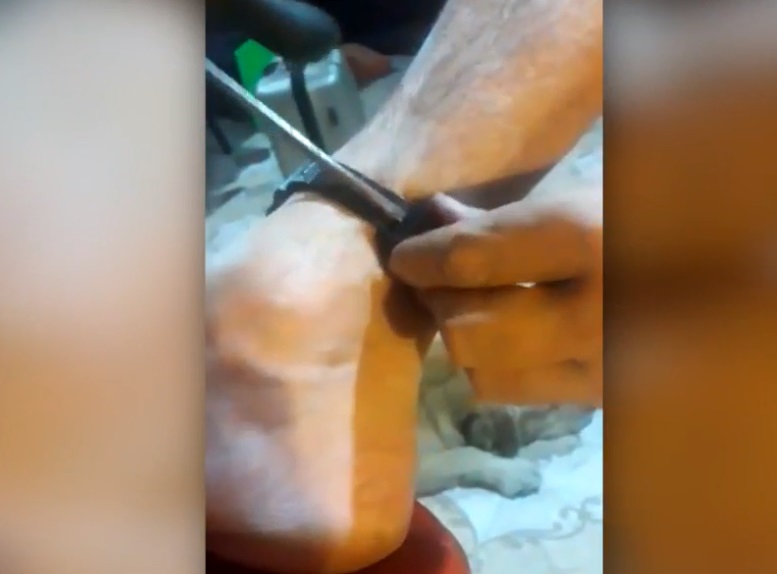 Rompió su pulsera electrónica estando en prisión domiciliaria y la descubrieron Rompió su pulsera electrónica estando en prisión domiciliaria y la descubrieron