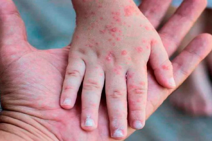 Viruela del mono: qué es, cómo se transmite y cuáles son sus síntomas