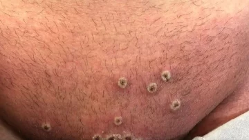 Confirman el sexto caso de viruela del mono en la Argentina