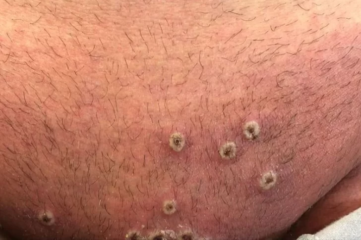 Detectan casos de viruela de mono en América