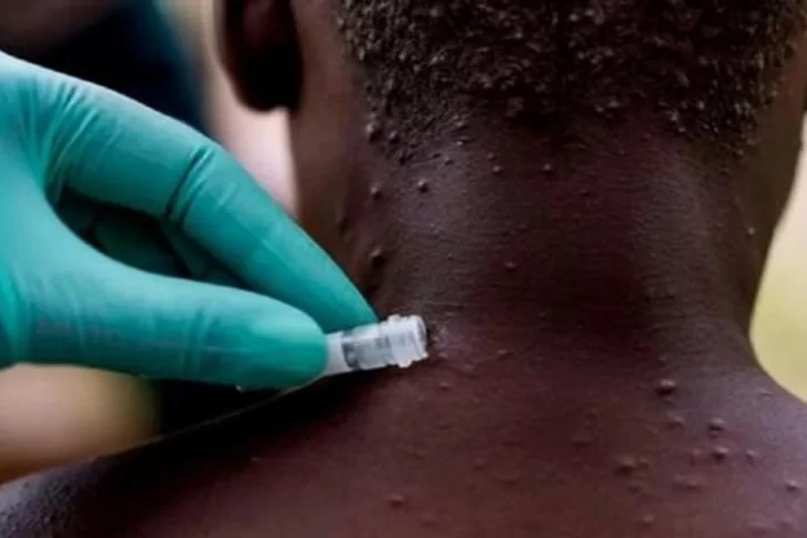 La OMS dijo que los casos de viruela del mono podrían ser la “punta del iceberg”