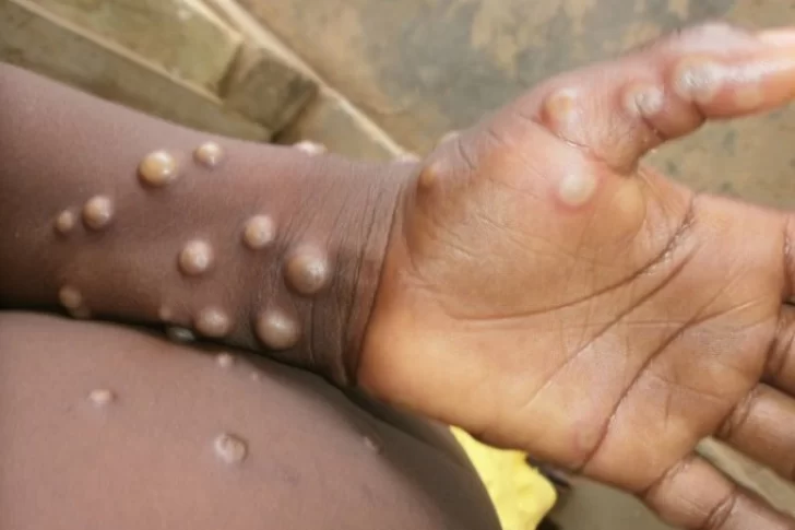 Hay más de 1.000 casos de viruela del mono y temen que se instale en países no endémicos