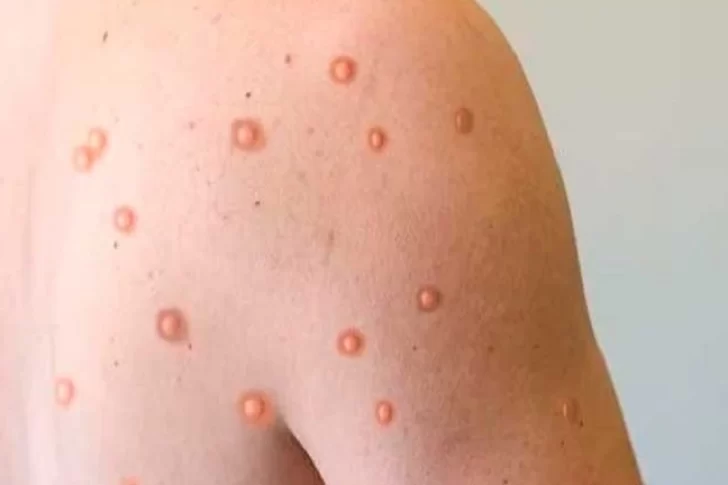 Con el de San Juan, ya hay 480 casos de viruela del mono en todo el país