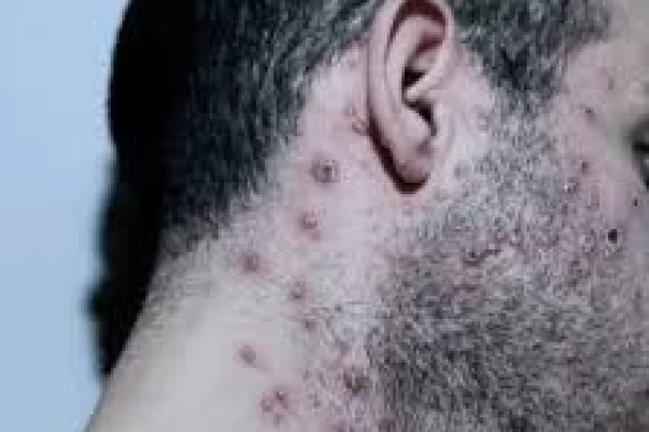 El Ministerio de Salud evalúa un segundo caso sospechoso de viruela del mono en Argentina