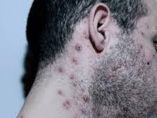 El Ministerio de Salud evalúa un segundo caso sospechoso de viruela del mono en Argentina