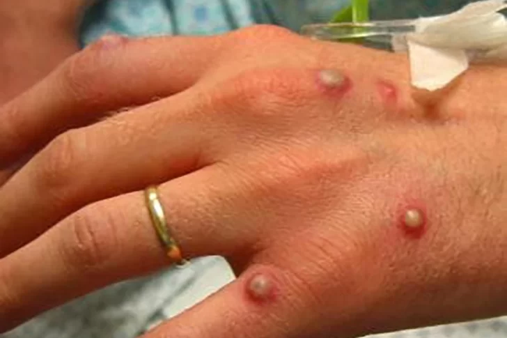 Viruela del mono: revelan datos acerca de las complicaciones que genera para la salud