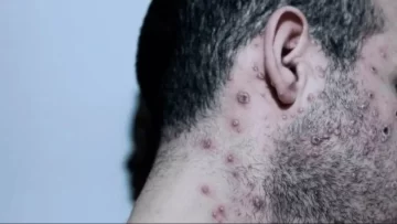 Estudio revela que 95% de casos de viruela del mono se transmite por actividad sexual Estudio revela que 95% de casos de viruela del mono se transmite por actividad sexual