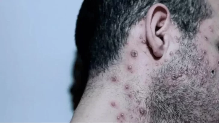 Estudio revela que 95% de casos de viruela del mono se transmite por actividad sexual Estudio revela que 95% de casos de viruela del mono se transmite por actividad sexual