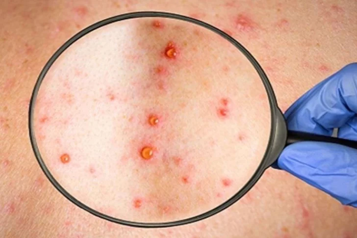 Un mendocino, el cuarto caso de viruela de mono en Argentina