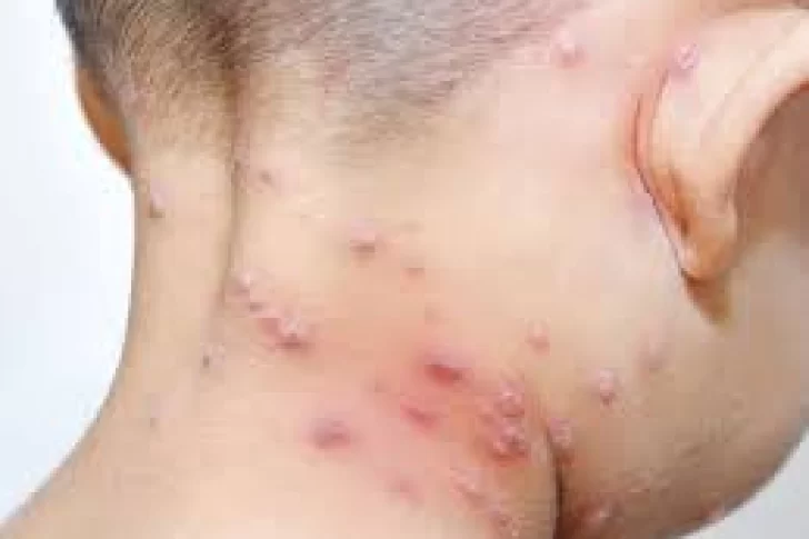 La OMS confirmó más de 5.000 casos de viruela del mono en el mundo