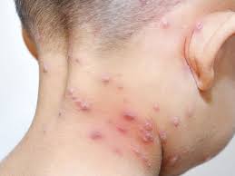 La OMS confirmó más de 5.000 casos de viruela del mono en el mundo La OMS confirmó más de 5.000 casos de viruela del mono en el mundo