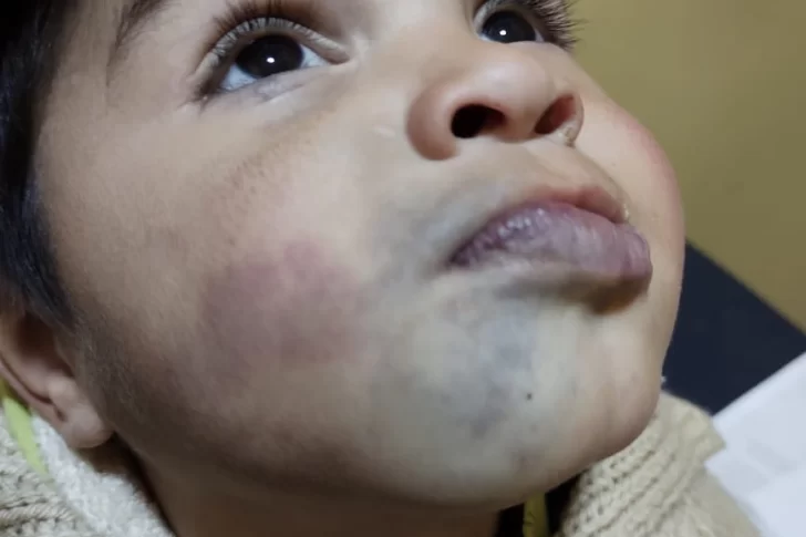 La dura historia de Eithan, el nene que vive desde que nació con una malformación en su cara