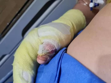 Explotó un experimento en una feria de ciencias y un nene terminó internado Explotó un experimento en una feria de ciencias y un nene terminó internado