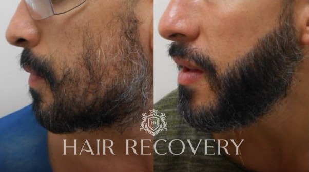 Microtrasplante de barba: lo que hay que saber sobre la intervención capilar del momento Microtrasplante de barba: lo que hay que saber sobre la intervención capilar del momento