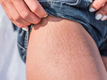 Estrías, las heridas de la piel Estrías, las heridas de la piel