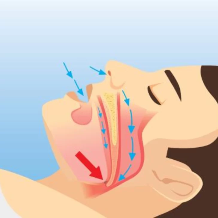 Manejar con apneas de sueño, un riesgo si no se trata a tiempo Manejar con apneas de sueño, un riesgo si no se trata a tiempo