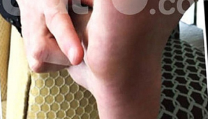 El pie derecho de Lionel Messi, en evidente mal estado El pie derecho de Lionel Messi, en evidente mal estado