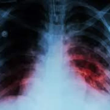 El 85% de las personas con tuberculosis que acceden al tratamiento, se curan El 85% de las personas con tuberculosis que acceden al tratamiento, se curan