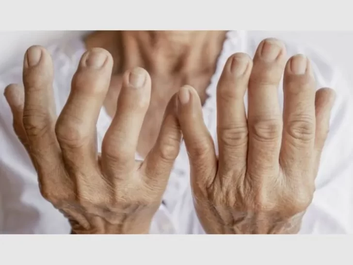 Artrosis, una enfermedad degenerativa que afecta a 3 millones de personas en Argentina y puede tratarse a tiempo