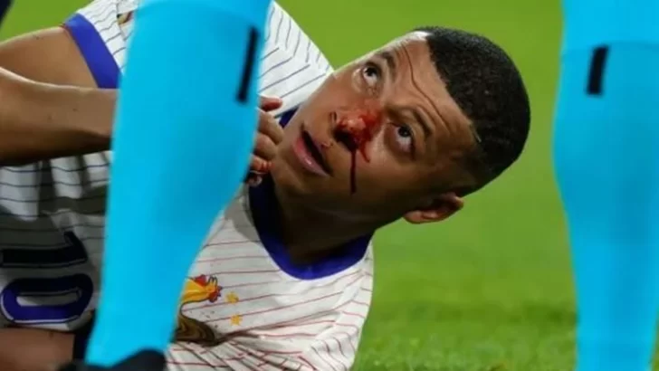 mbappe-nariz-728x410